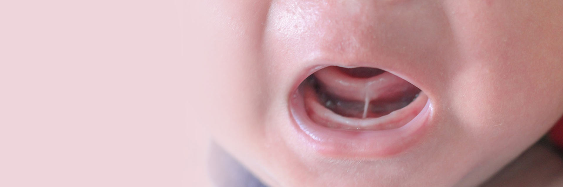 Learn More About Tongue Tie?